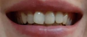 Причина обращения - желание без использования брекет системы исправить положение передних зубов