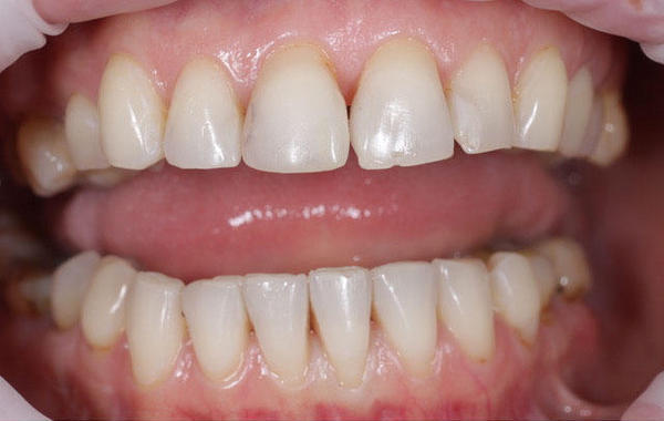 Причина обращения - желание изменить форму и цвет зубов, нормализовать функцию жевания