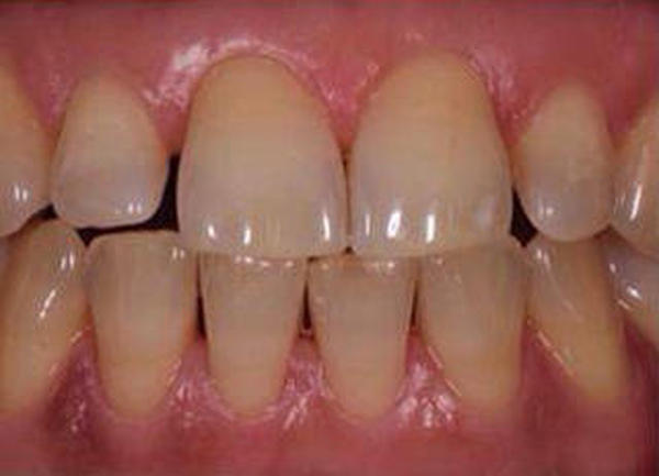 Пациентка обратилась с проблемой - промежутки между зубами, тёмный цвет зубов