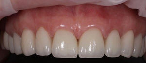 Причина обращения - улучшение эстетики и восстановление функции жевательных зубов