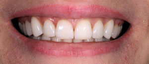Причина обращения - желание улучшить эстетику улыбки без заметного изменения цвета зубов
