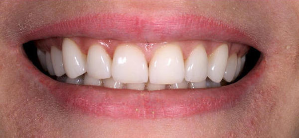 Причина обращения - желание улучшить эстетику улыбки без заметного изменения цвета зубов