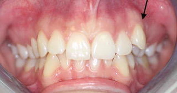 Причина обращения - суправестибулярное положение зуба 23