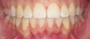 Причина обращения - суправестибулярное положение зуба 23