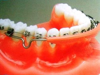 Использование губного бампера в ортодонтии