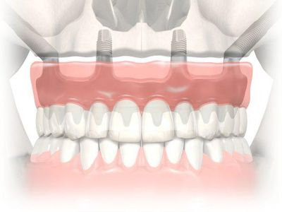 Система имплантации зубов Nobel Biocare