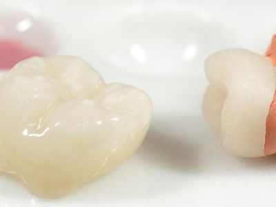 Какие бывают виды зубных протезов?