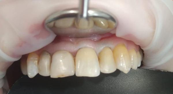 Причина обращения - коррекция эстетики передних зубов после ортодонтического лечения