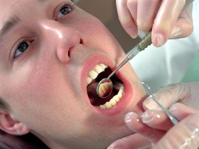 Лечение кисты зуба (гранулемы)