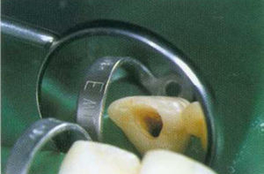 Эндоотбеливание зубов (Внутреннее отбеливание)