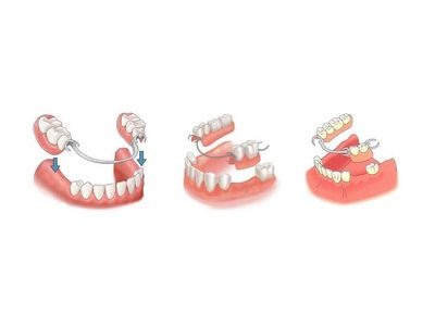 Съемные протезы для зубов