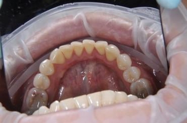 Пескоструйная чистка зубов