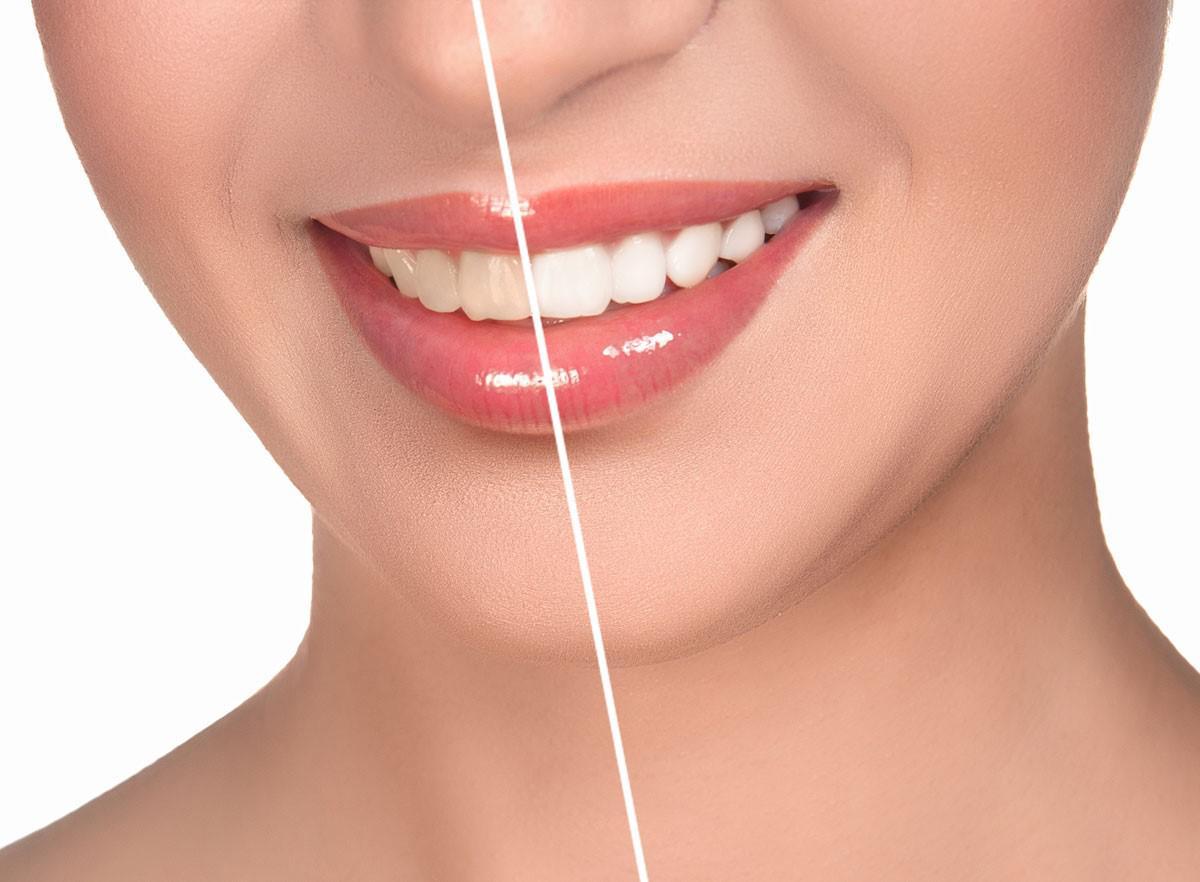 Как отбелить зубы дома без вреда для эмали? | Kurtova Dental Clinic