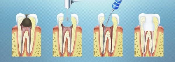Почему болит зуб без нерва?