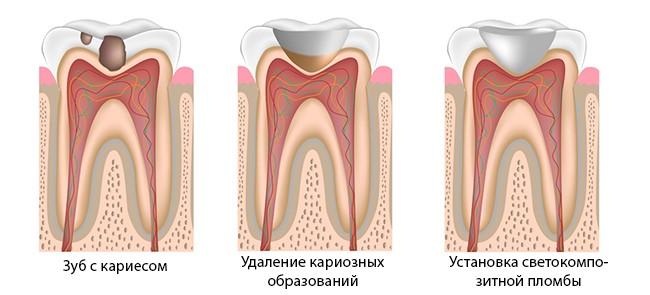 Противопоказания при депульпировании зубов