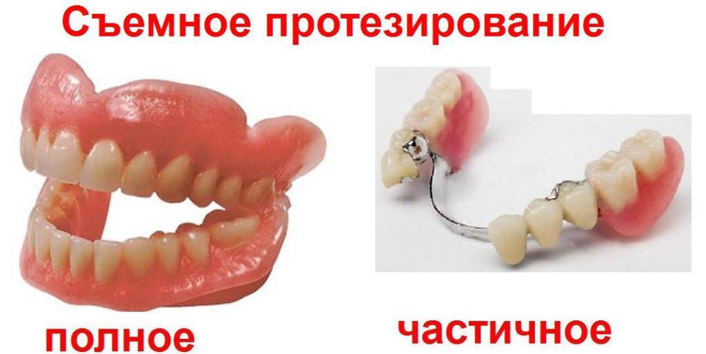 какие виды зубных протезов существуют