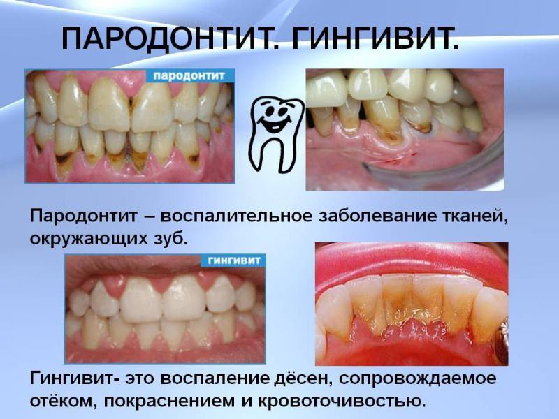 Какие заболевания десен бывают детская стоматология томск 1