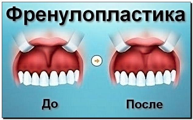 Пластика уздечки языка Томск Трамвайная стоматология эталон томск врачи