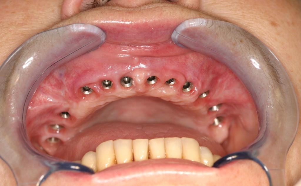 Базальная имплантация зубов Томск Вавилова