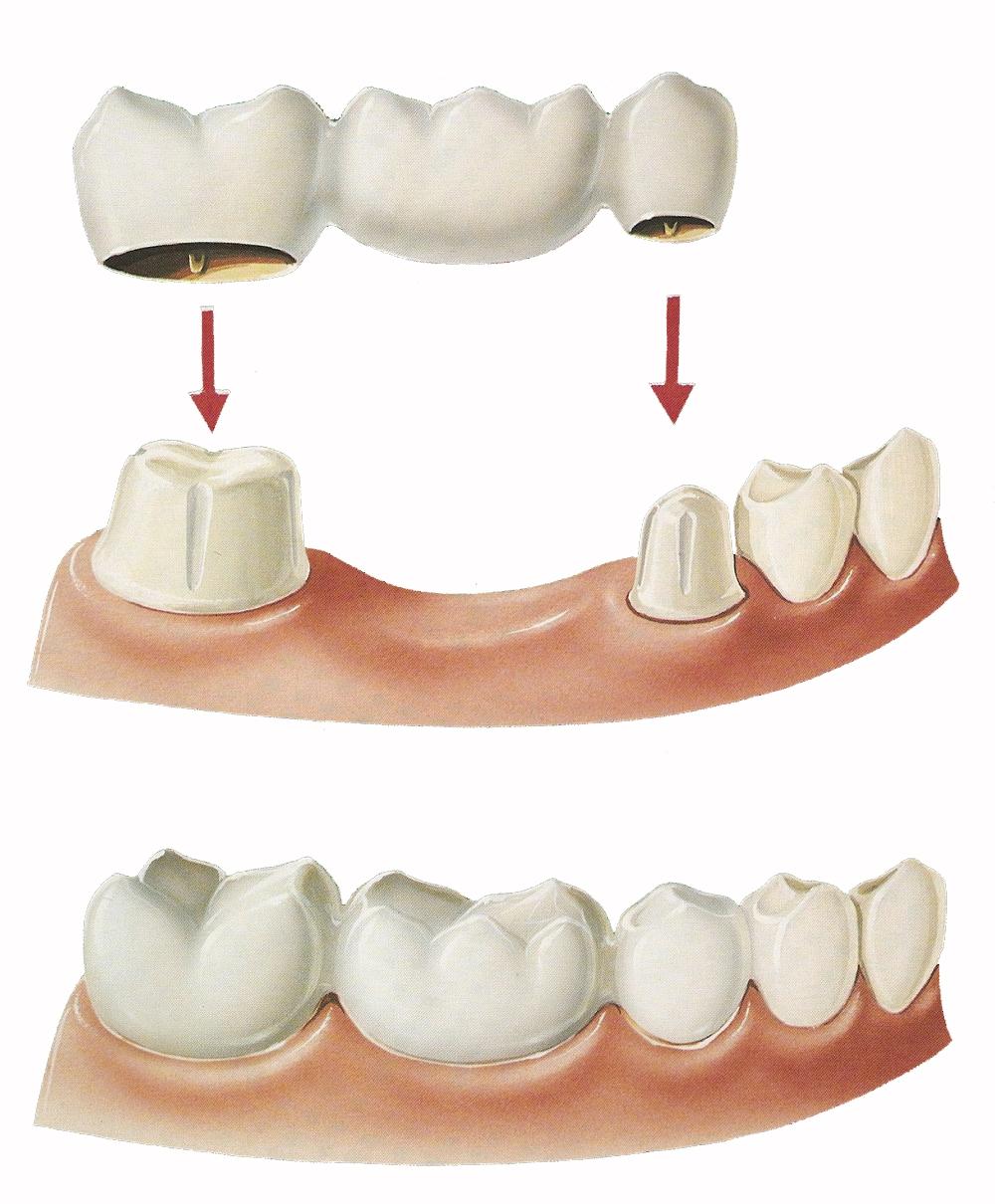 Через сколько можно вставлять зубы. Мостовидные протезы классификация. Зубной мост мостовидный протез. Консольный мостовидный протез. Мостовидный зубной несъемный протез.