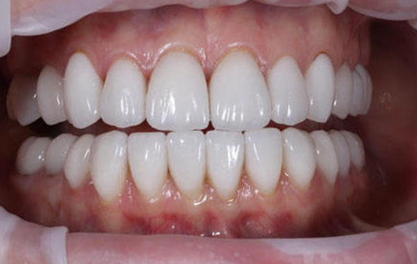 Причина обращения - желание изменить форму и цвет зубов, нормализовать функцию жевания