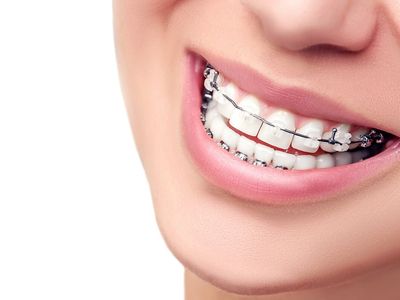 Выравнивание зубов без брекетов