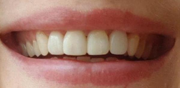 Причина обращения - желание без использования брекет системы исправить положение передних зубов