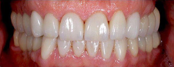 Причина обращения - повышенная стираемость зубов, неудовлетвортельная эстетика, желание пациента улыбаться без стеснения