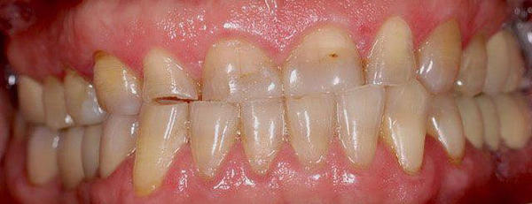 Причина обращения - повышенная стираемость зубов, неудовлетвортельная эстетика, желание пациента улыбаться без стеснения