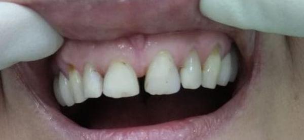 Причина обращения - улучшение эстетически зубов