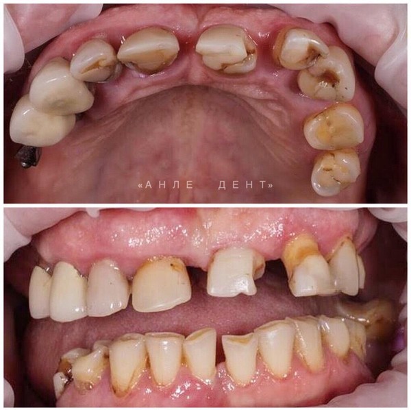 Пациент обратился с жалобой на отсутсвие зубов, затруднённое жевание