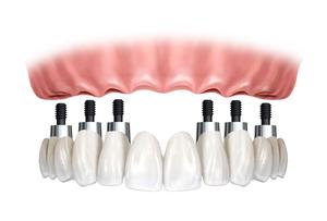 Система имплантации зубов Hi Tec Implants