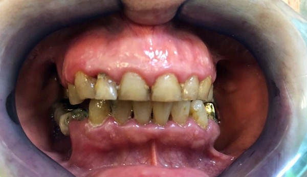 Лазерная имплантация зубов