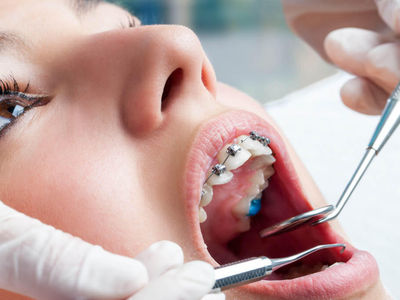 Брекеты или элайнеры, что нужно для выравнивая зубов?
