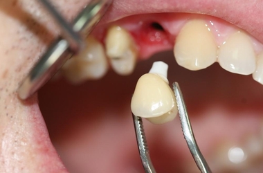Несъемные протезы для зубов