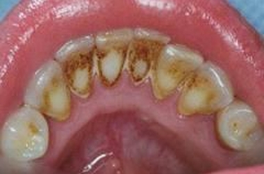 Чистка зубов с брекетами у стоматолога
