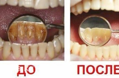 Удаление зубного налета