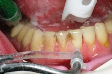 Ультразвуковая чистка зубов